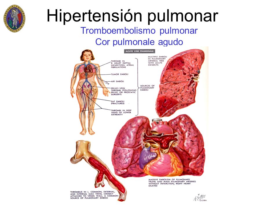 Hipertensión pulmonar y afib Hipertensión pulmonar y afib